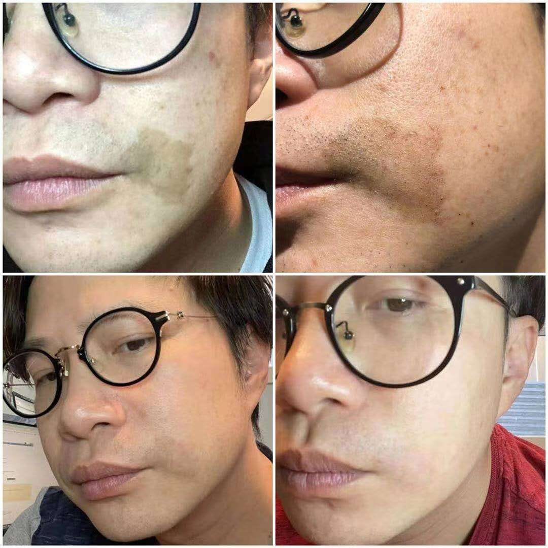 ND: YAG Q SWITCH - ليزر إزالة الوشم والنمش والتصبغات الجلدية - الصورة 4