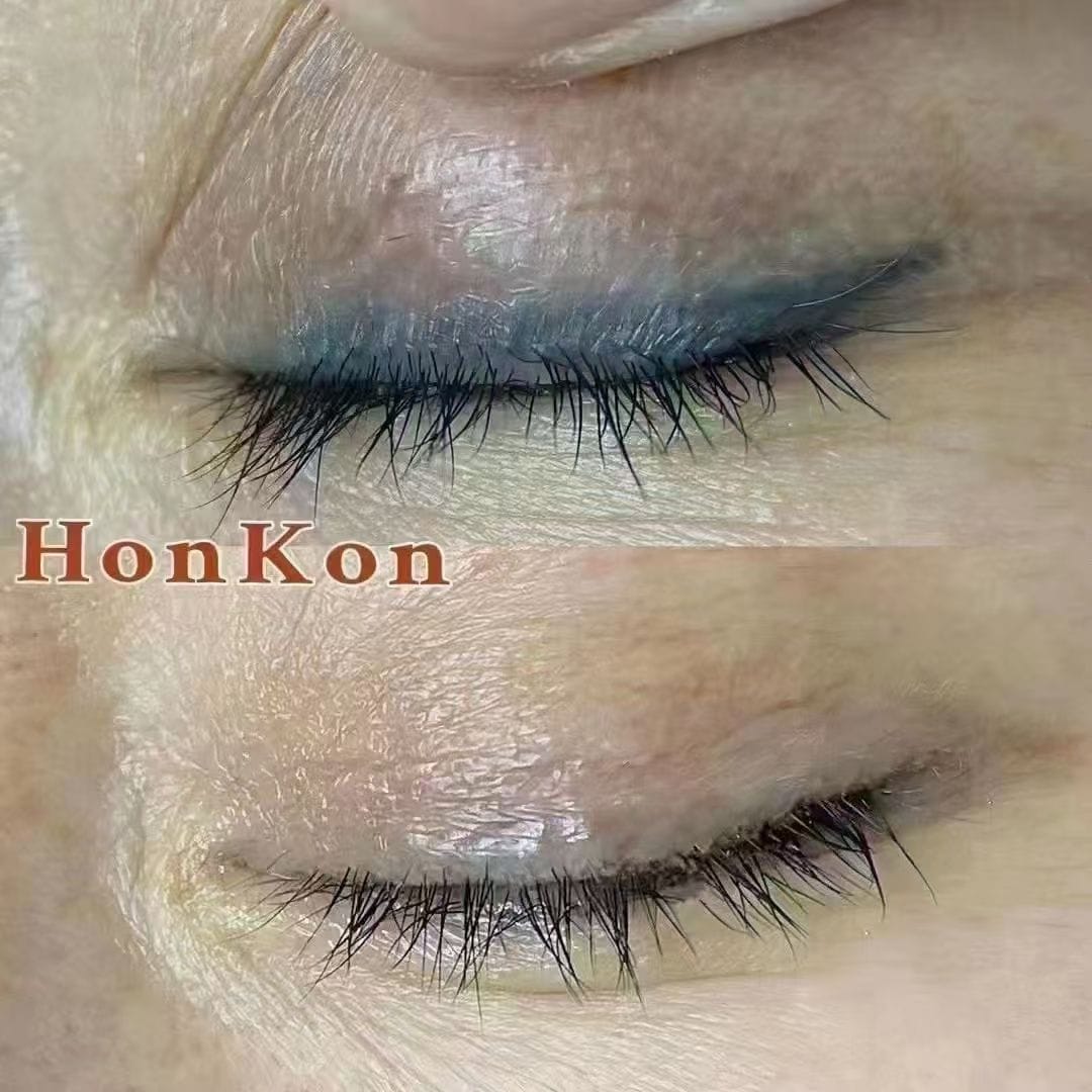 ND: YAG Q SWITCH - ليزر إزالة الوشم والنمش والتصبغات الجلدية - الصورة 3