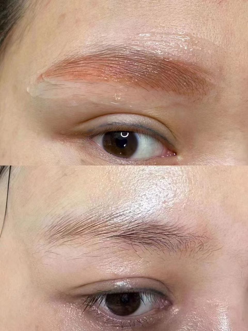 ND: YAG Q SWITCH - ليزر إزالة الوشم والنمش والتصبغات الجلدية - الصورة 2